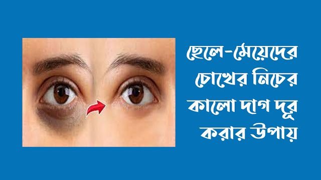 চোখের নিচের কালো দাগ দূর করার উপায়