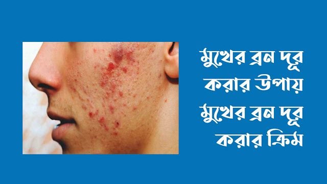 মুখের ব্রন দূর করার উপায়