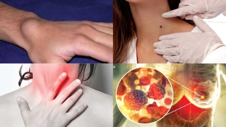 টিউমার চেনার উপায়