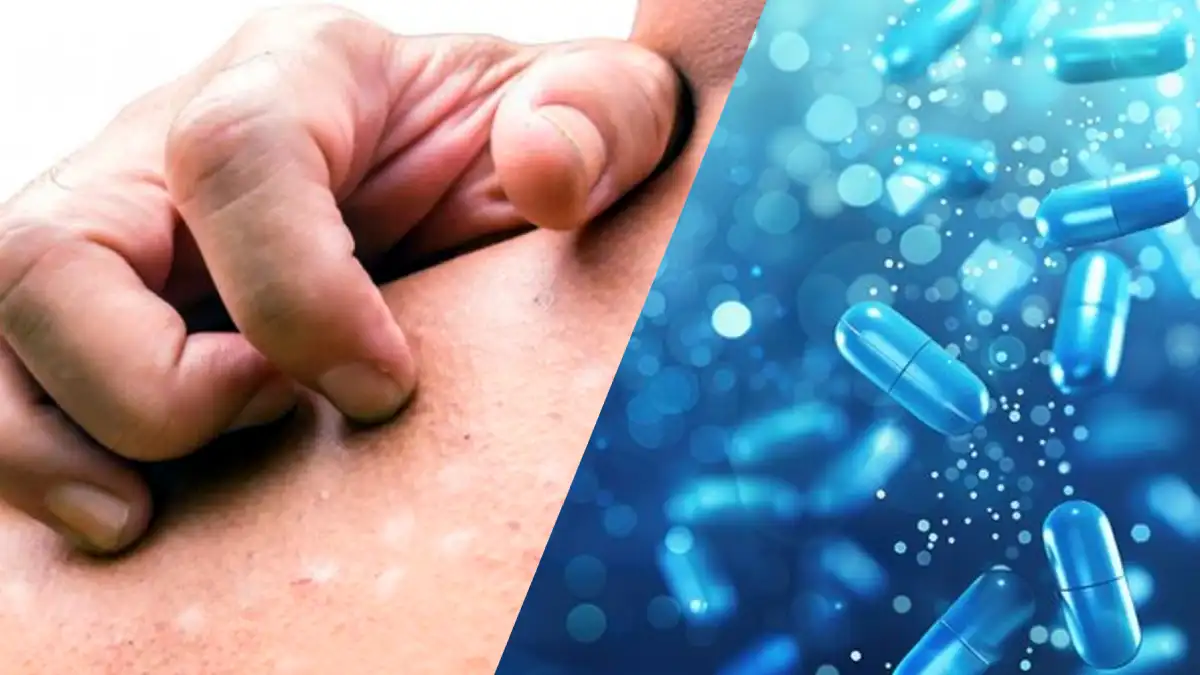 ছুলি দূর করার ক্রিমের নাম